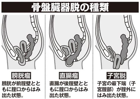 骨盤臓器脱 （子宮脱・性器脱）｜婦人科【千船病院